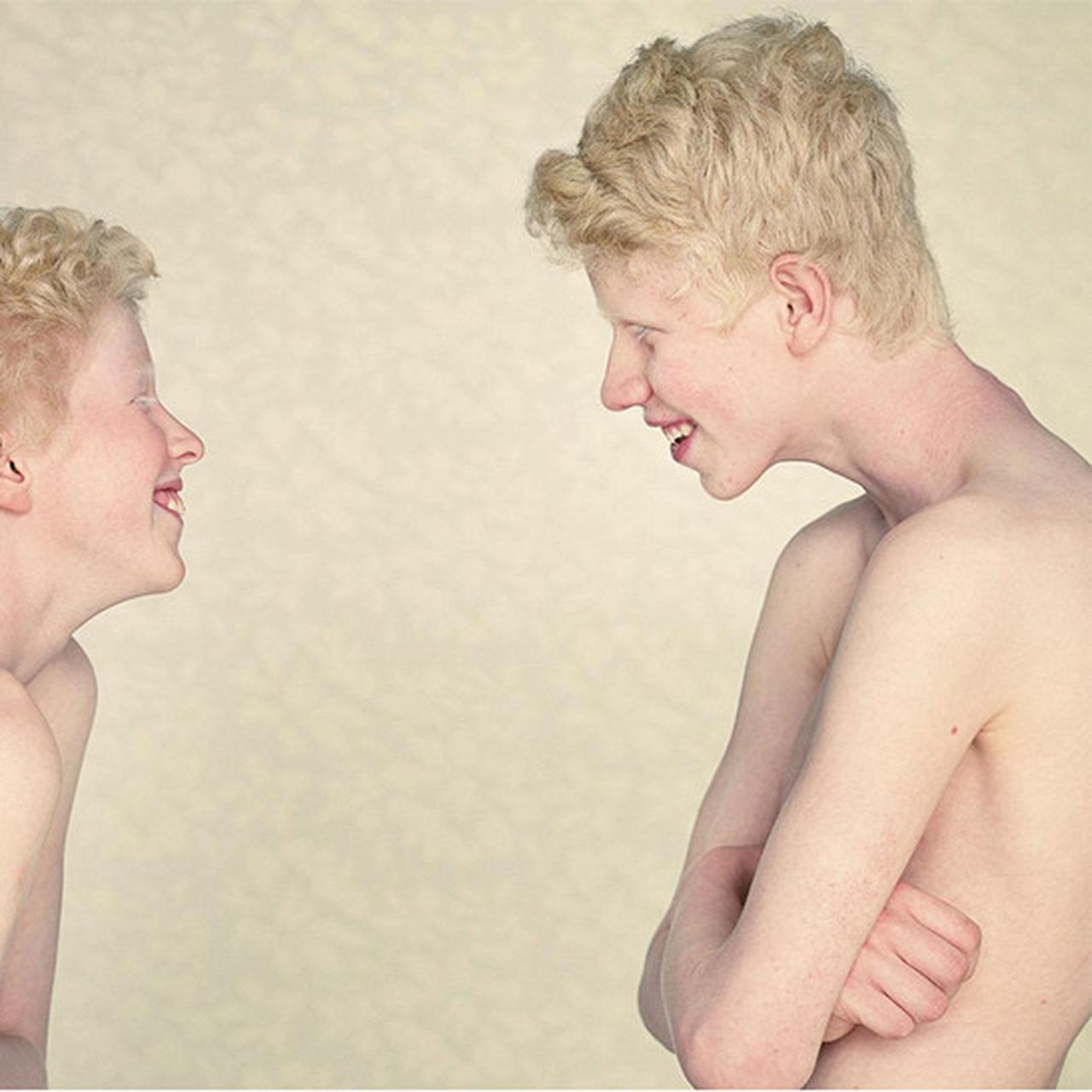 Albino Nipples