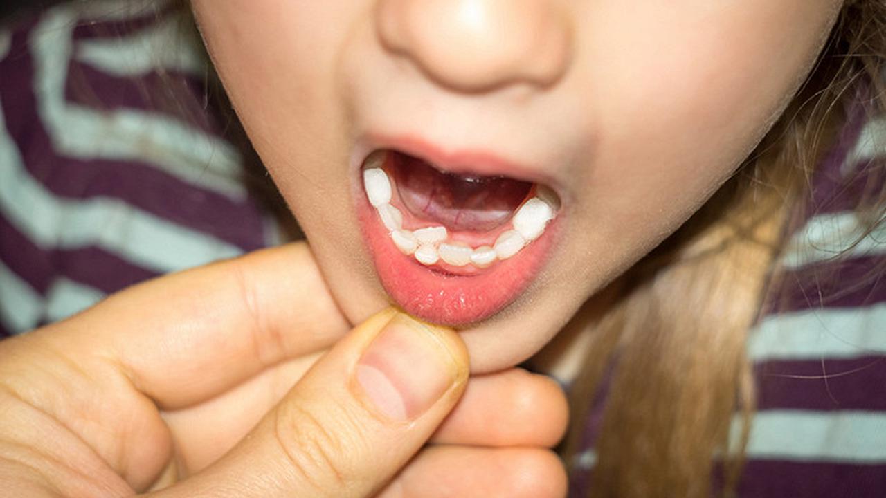 У ребёнка не выпали молочные зубы, но под ними растут коренные: что делать