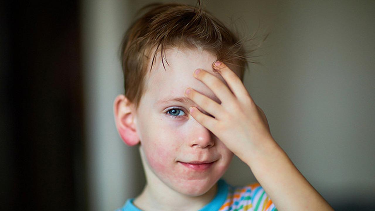 Крапивница у детей: симптомы и лечение - Летидор