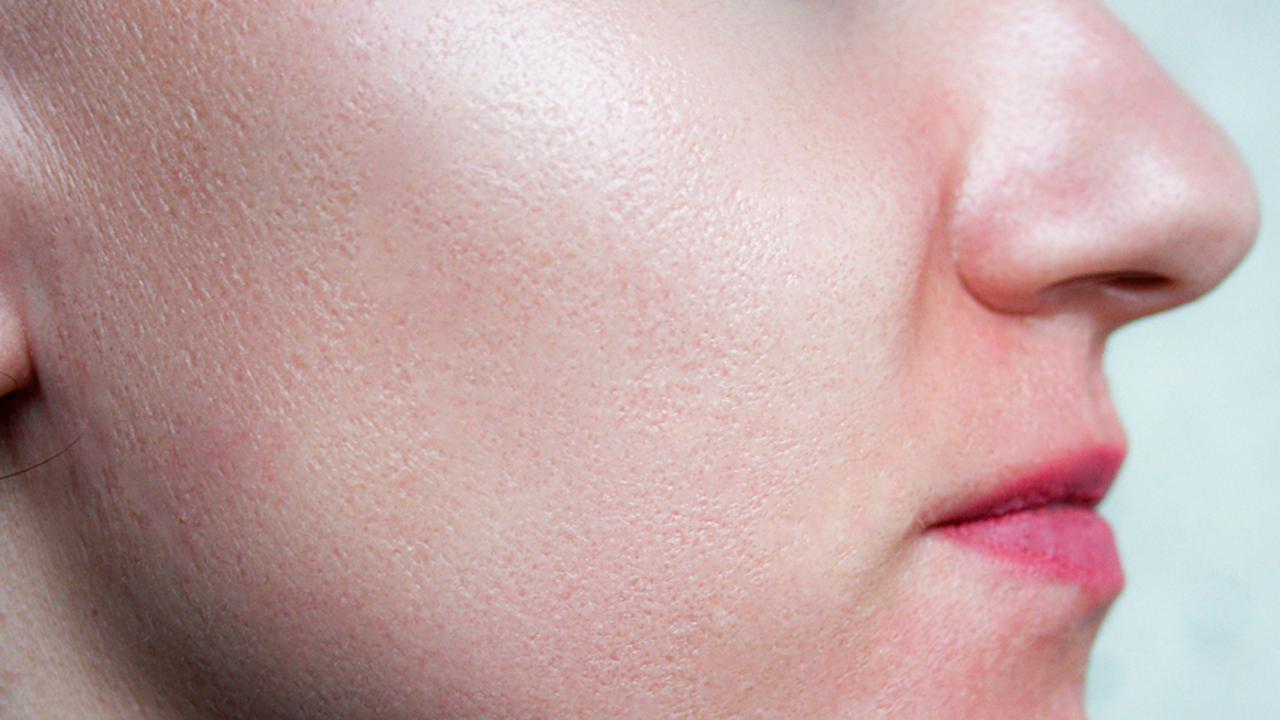 Расширенные поры на лице: причины их появления и варианты уменьшения пор