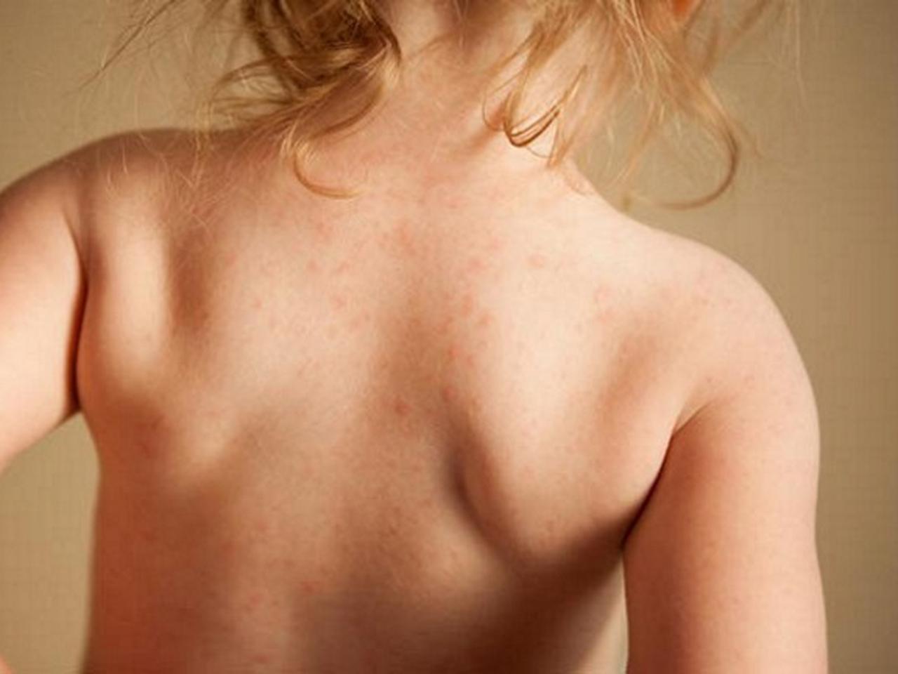 розовый лишай у женщин на груди фото 32