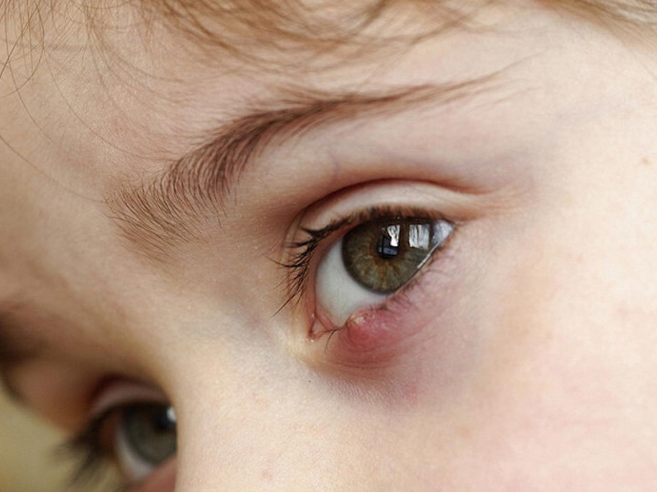 Ячмень на глазу у ребенка — причины и лечение
