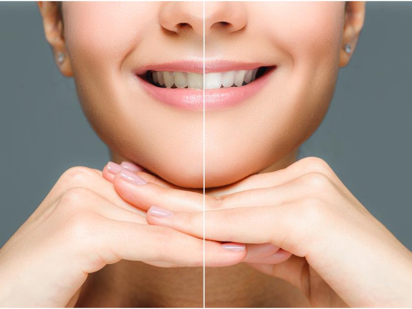 Старение эмали зубов